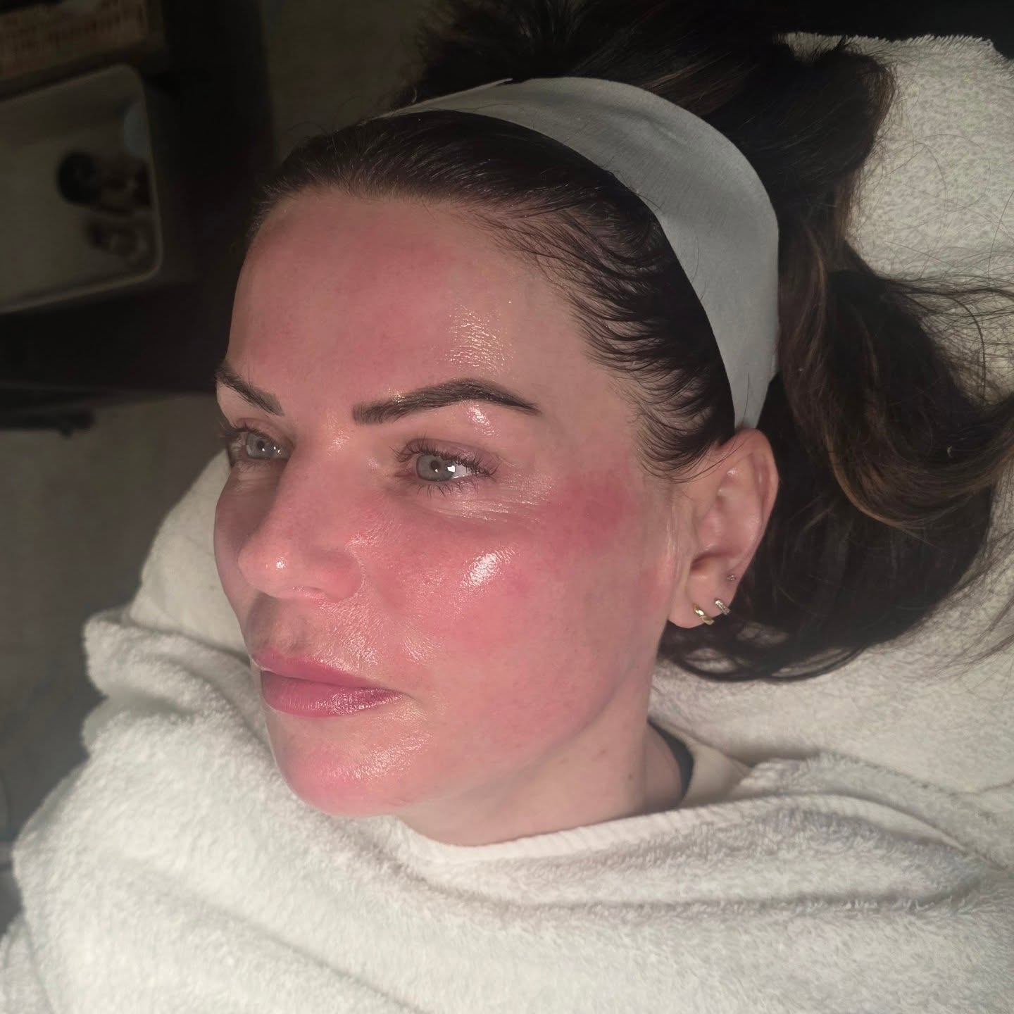 Brow treatment result